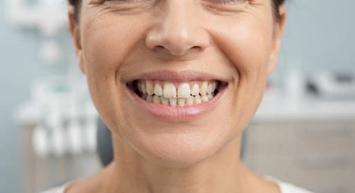 Before dental teeth whitening: yellow stained teeth